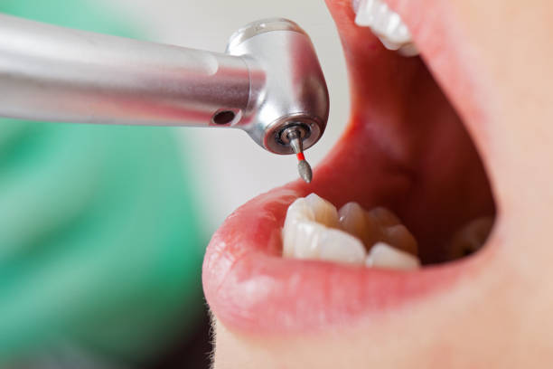Best Chipped Tooth Repair Near Me  in South Charleston, OH